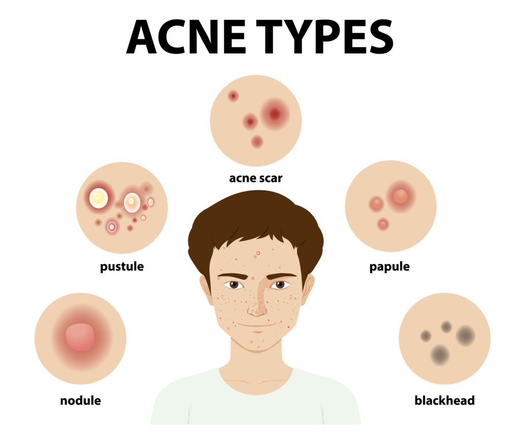 acne types