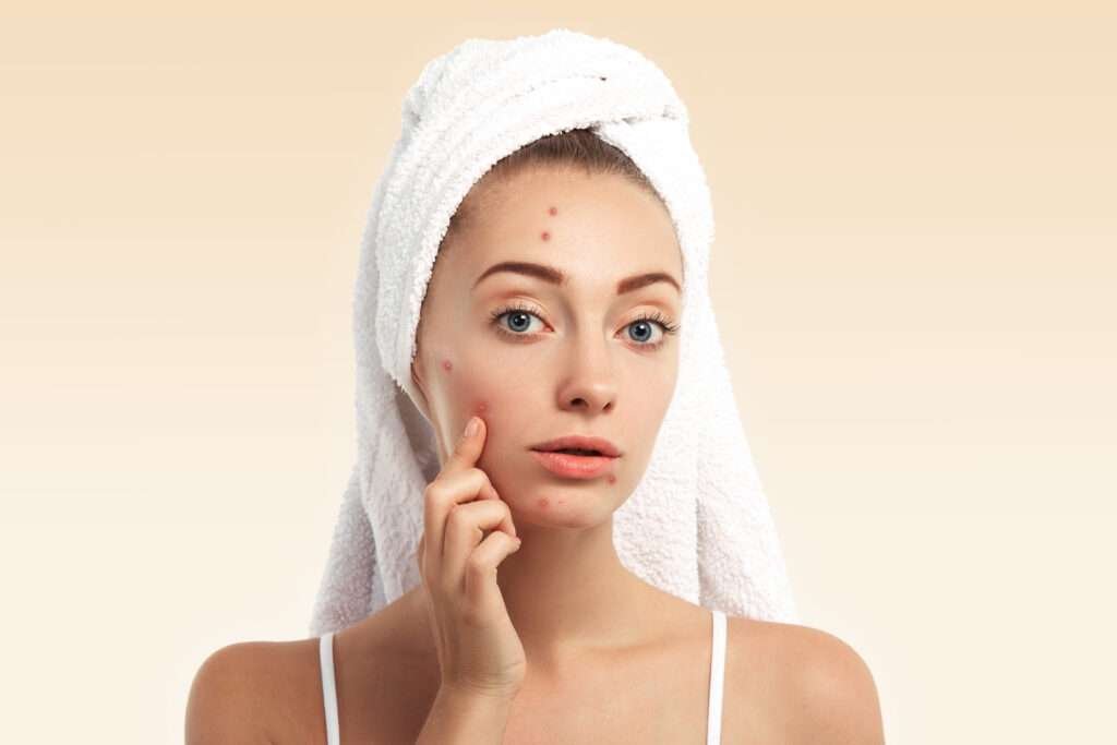 pimples on woman face, About acne treatment